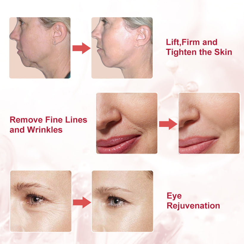 SUNMAY VSkin Radio Frequency & EMS Technology 2 in 1 Face Lift Device ...